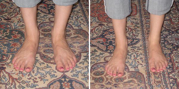aebt-foot-therapy-before-and-after